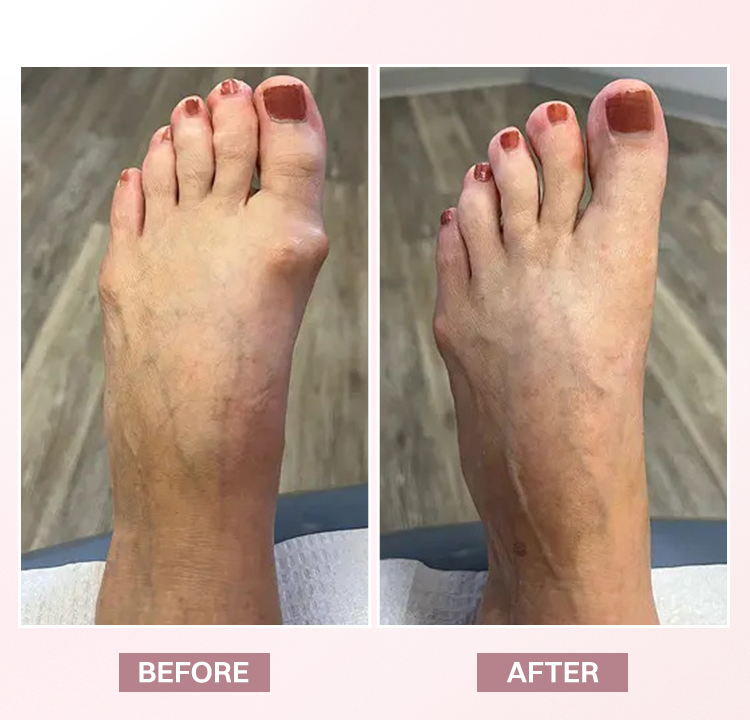 LIMETOW® Bunion Relief Brace