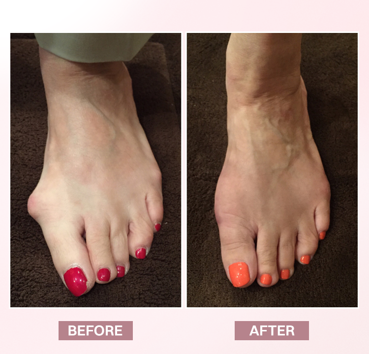 LIMETOW® Bunion Relief Brace
