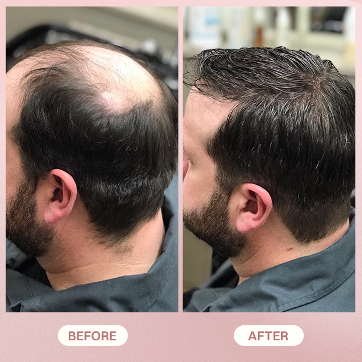 LIMETOW® H-Regrow 2.0