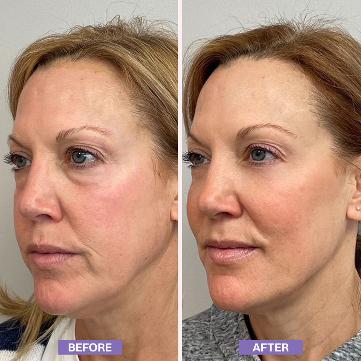 LIMETOW® Instant Lift Eye Gel