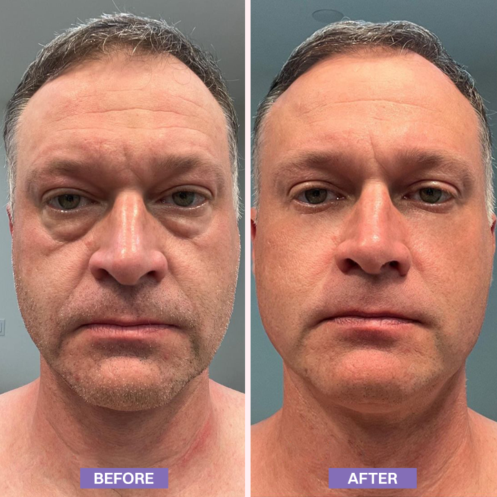 LIMETOW® Instant Lift Eye Gel