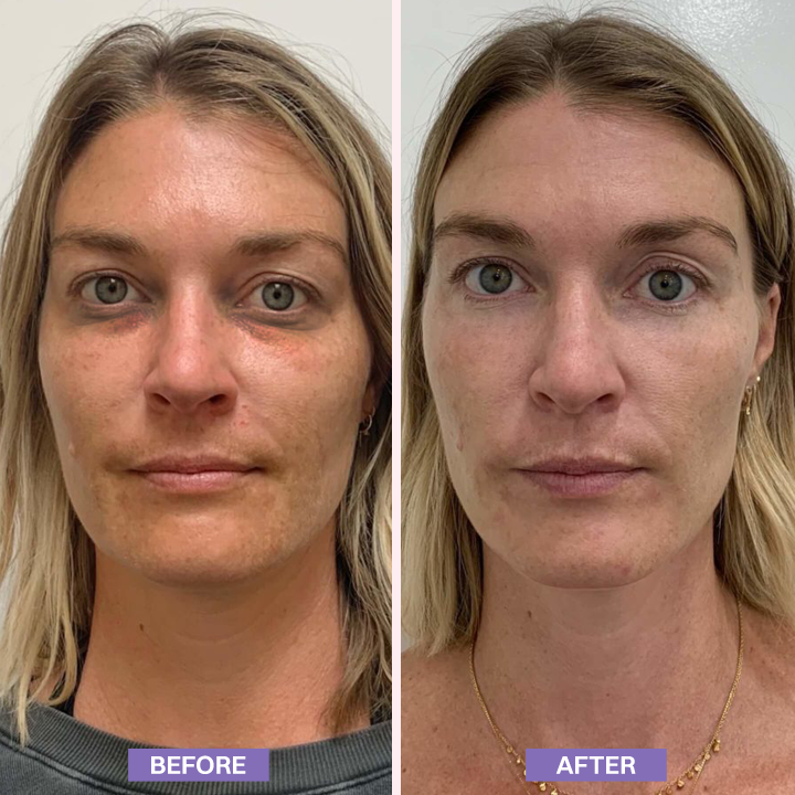 LIMETOW® Instant Lift Eye Gel