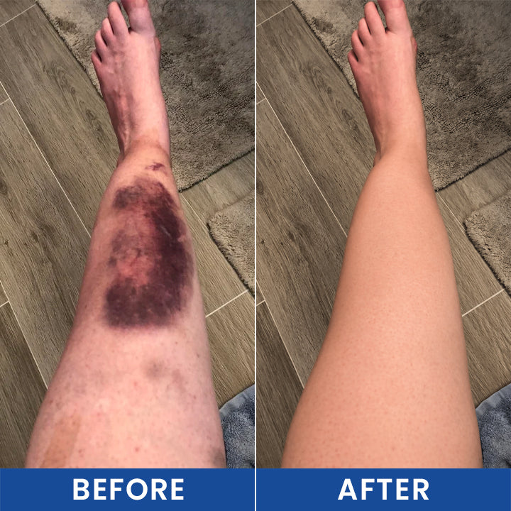 LIMETOW® Intensive Arnica Bruising Cream