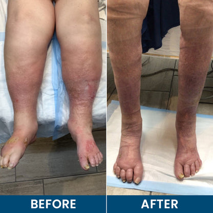 LIMETOW® Roll-On Relief Cream for Swelling & Lymphatic Drainage