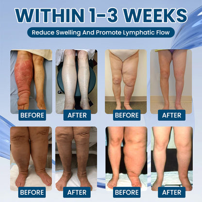LIMETOW® Roll-On Relief Cream for Swelling & Lymphatic Drainage