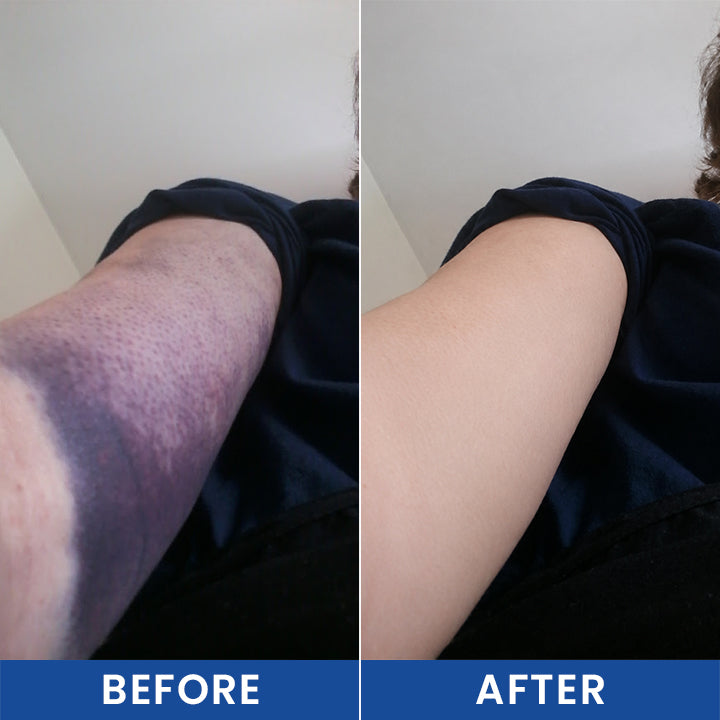 LIMETOW® Intensive Arnica Bruising Cream