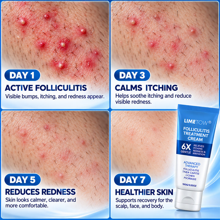 LIMETOW® FOLLICULITIS TREATMENT CREAM! TARGETED BOTANICAL CARE FOR RED, ITCHY, AND BUMPY SKIN!