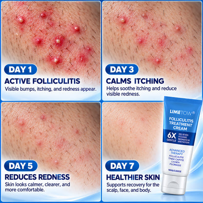 LIMETOW® FOLLICULITIS TREATMENT CREAM! TARGETED BOTANICAL CARE FOR RED, ITCHY, AND BUMPY SKIN!