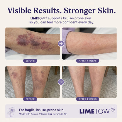 LIMETOW® Serum For bruise-prone,thin & sensitive skin