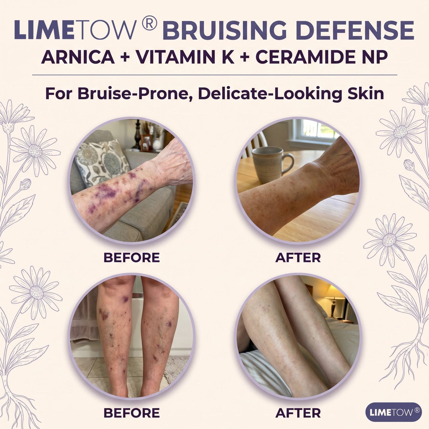 LIMETOW® Serum For bruise-prone,thin & sensitive skin