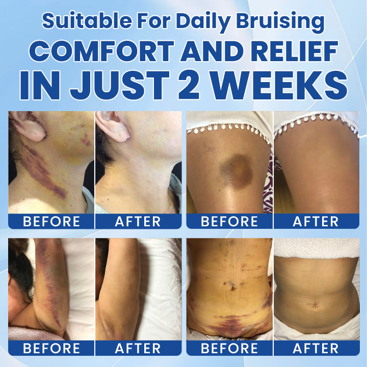 LIMETOW® Intensive Arnica Bruising Cream