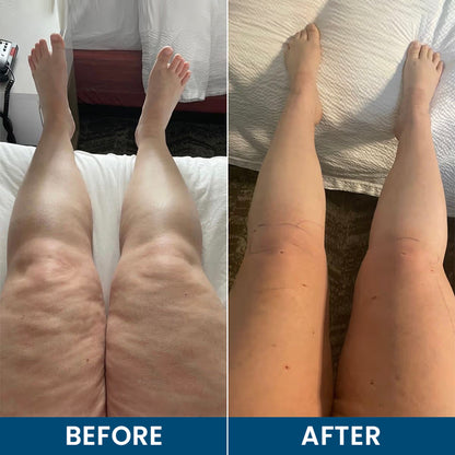 LIMETOW® Roll-On Relief Cream for Swelling & Lymphatic Drainage