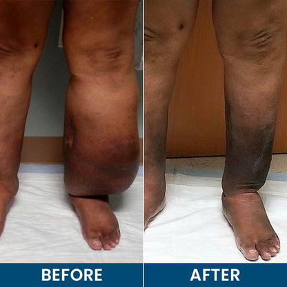 LIMETOW® Roll-On Relief Cream for Swelling & Lymphatic Drainage