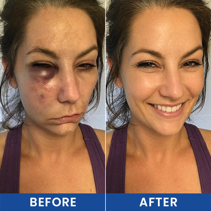 LIMETOW® Intensive Arnica Bruising Cream