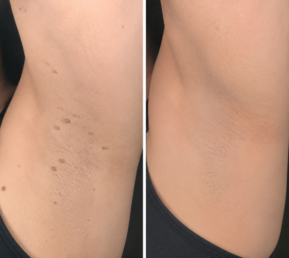 LIMETOW® 2-in-1 Microneedle & Hydrocolloid Patch🍀 | Removes Raised Moles, Acne, Flat Warts, Skin Tags, Milia & Age Spots | No Surgery Needed | Invisible Skin Treatment for Face & Body | 90-Day Money-Back Guarantee