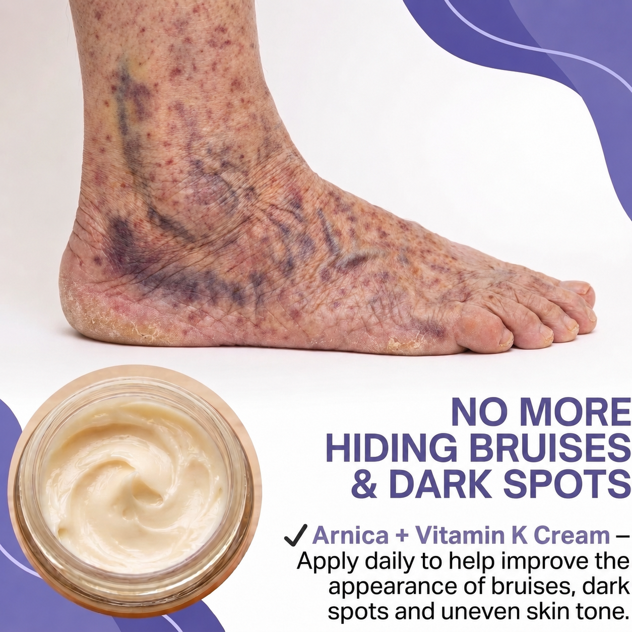 10K+ SOLD 🔥Dark Spot & Bruise Recovery Cream ✨  Helps Improve the Look of Dark Spots & Uneven Body Tone