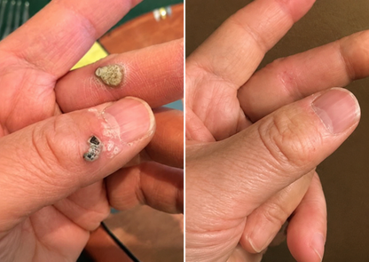 LIMETOW® 2-in-1 Microneedle & Hydrocolloid Patch🍀 | Removes Raised Moles, Acne, Flat Warts, Skin Tags, Milia & Age Spots | No Surgery Needed | Invisible Skin Treatment for Face & Body | 90-Day Money-Back Guarantee