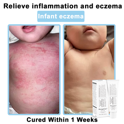 【Official US Store🔥】JAK-Smart Ruxolitinib Repair Complex 🌿（Zero Inflammation, 72H Sustained Release | Acne Clear in 10 Days | 97.7% Redness Reduction | Clinically Tested）